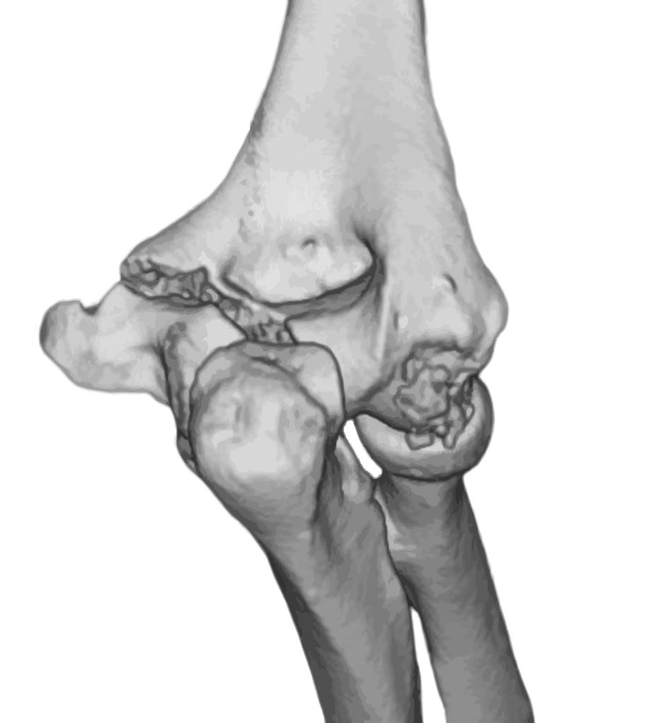 X-ray of a fractured elbow