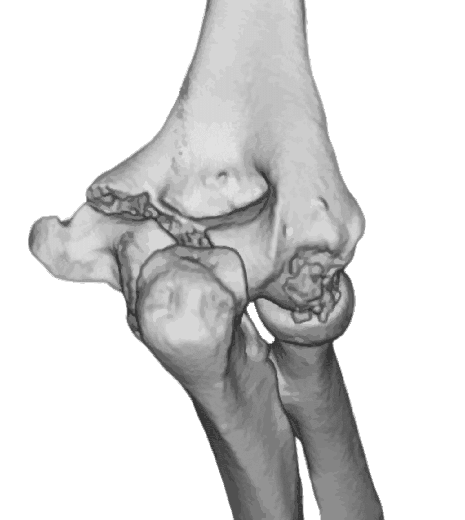 X-ray of a fractured elbow