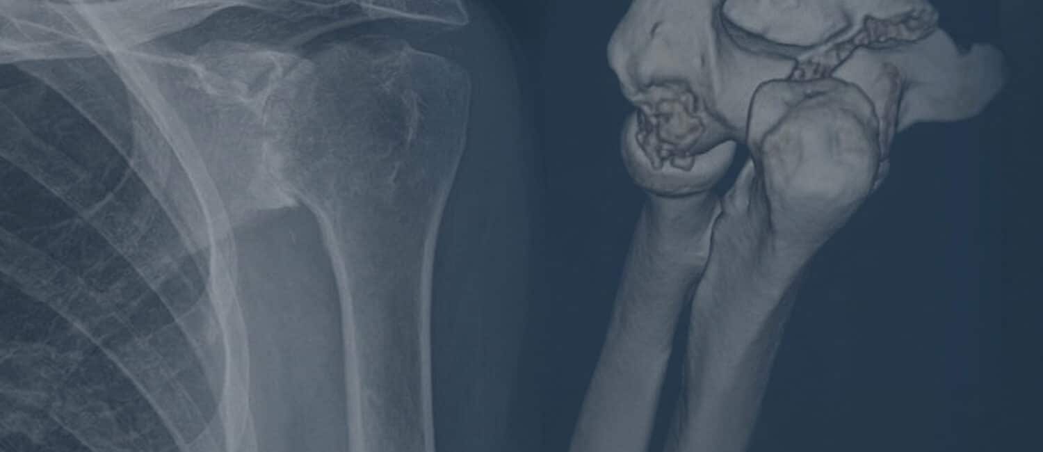 Blended shoulder and elbow X-ray images used as a header background representing shoulder and elbow surgery
